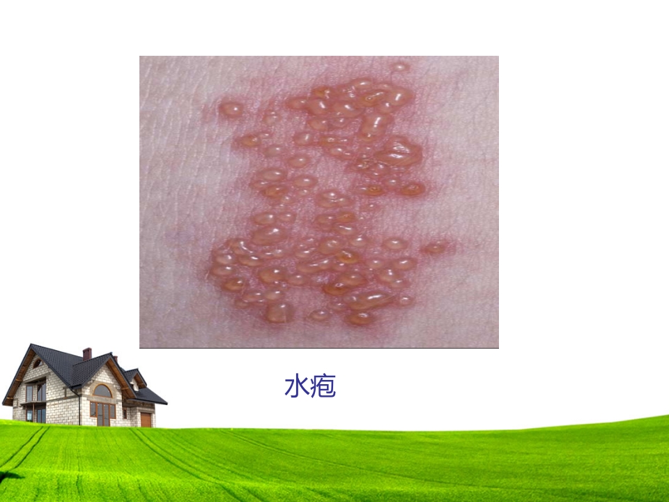 带状疱疹患者的护理及健康宣教