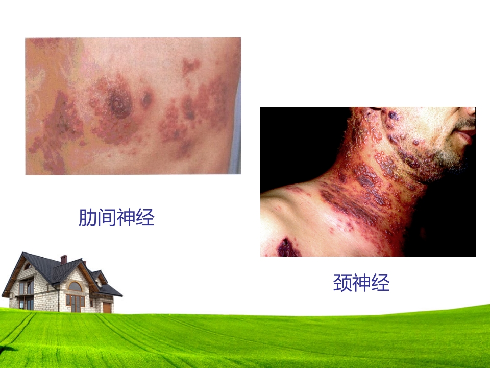 带状疱疹患者的护理及健康宣教