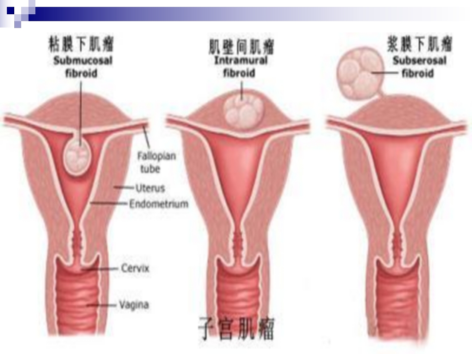 二病区子宫肌瘤健康宣教