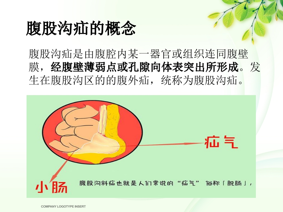 腹股沟斜疝健康宣教
