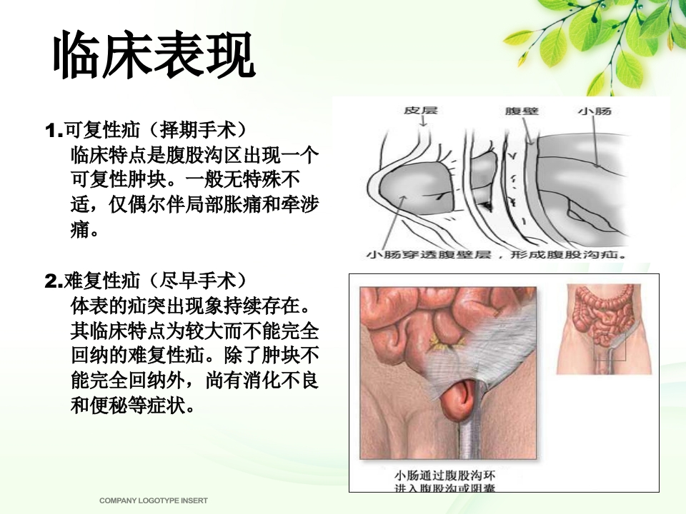 腹股沟斜疝健康宣教