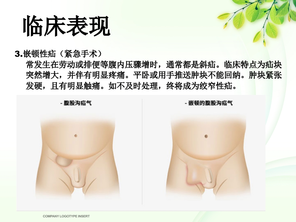 腹股沟斜疝健康宣教