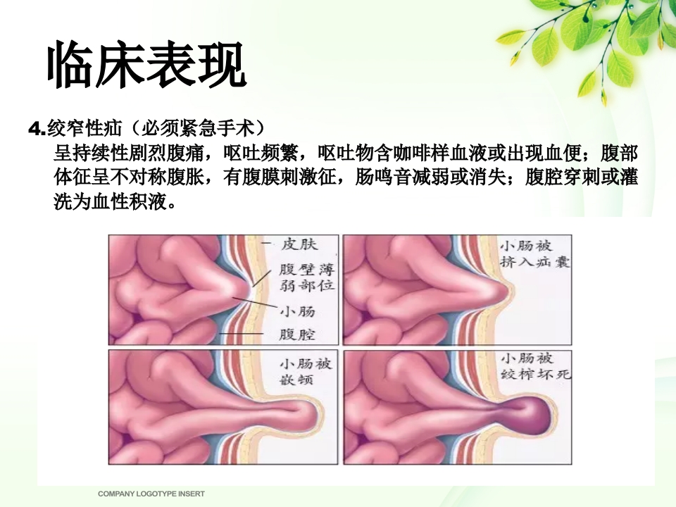 腹股沟斜疝健康宣教