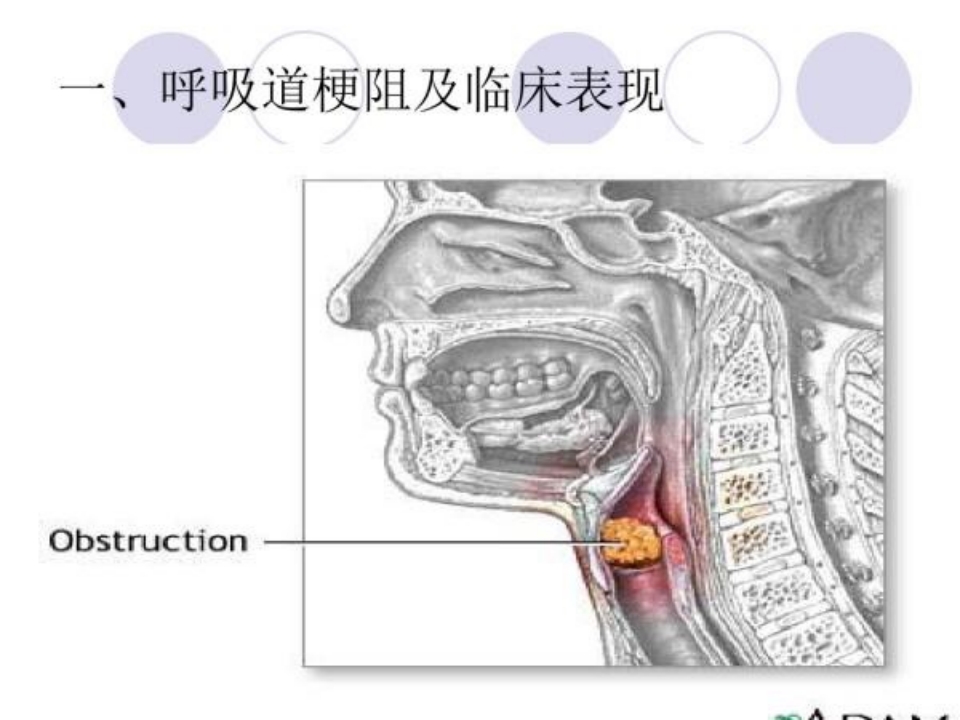 海姆立克急救法