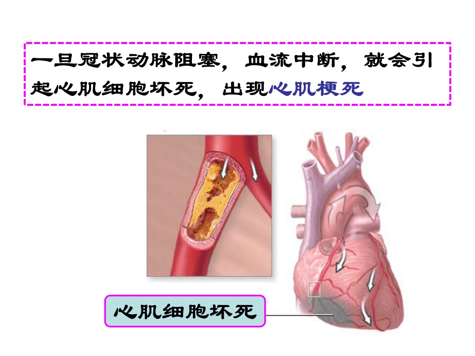 呵护心肌梗死支架患者