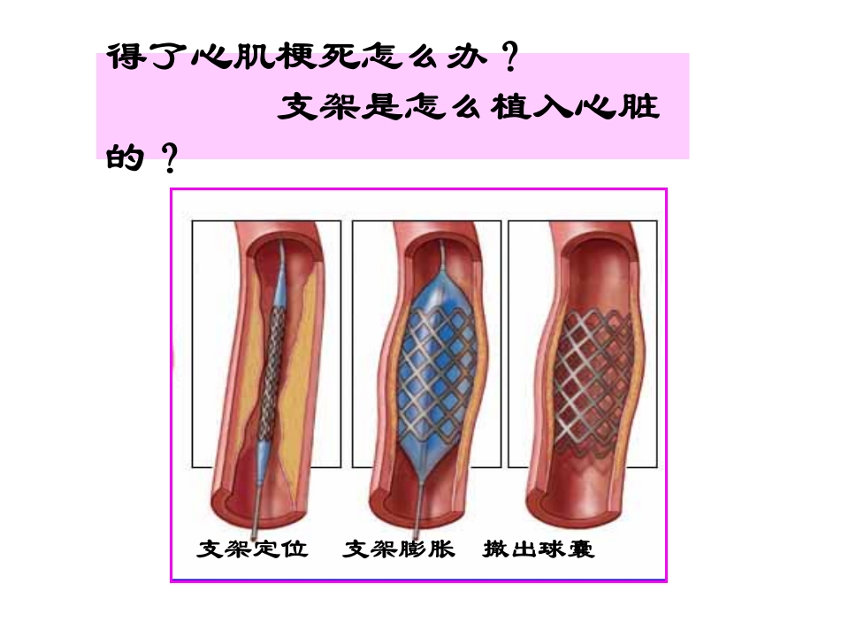 呵护心肌梗死支架患者