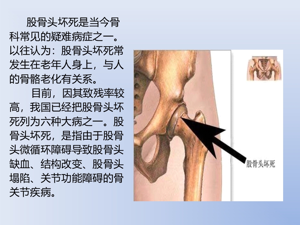 浅谈股骨头坏死