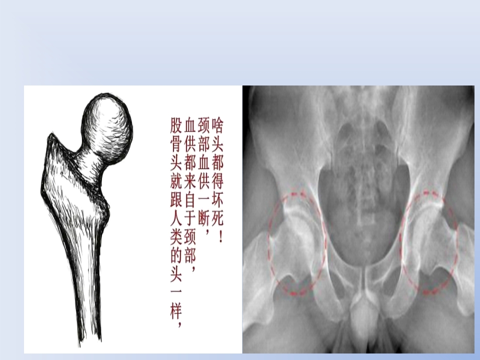 浅谈股骨头坏死