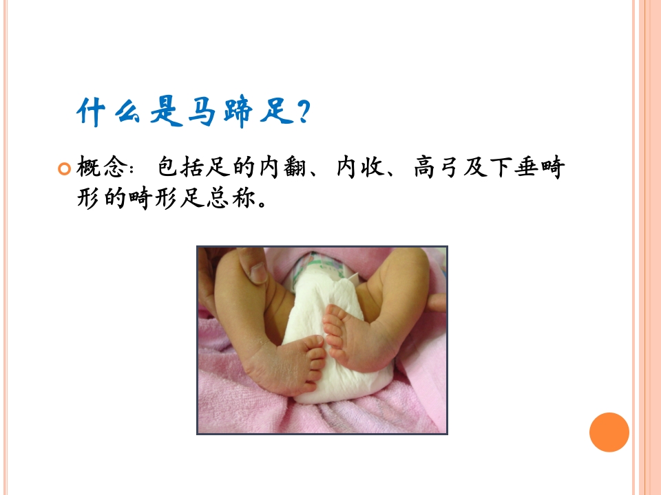 先天性马蹄内翻足的早期治疗