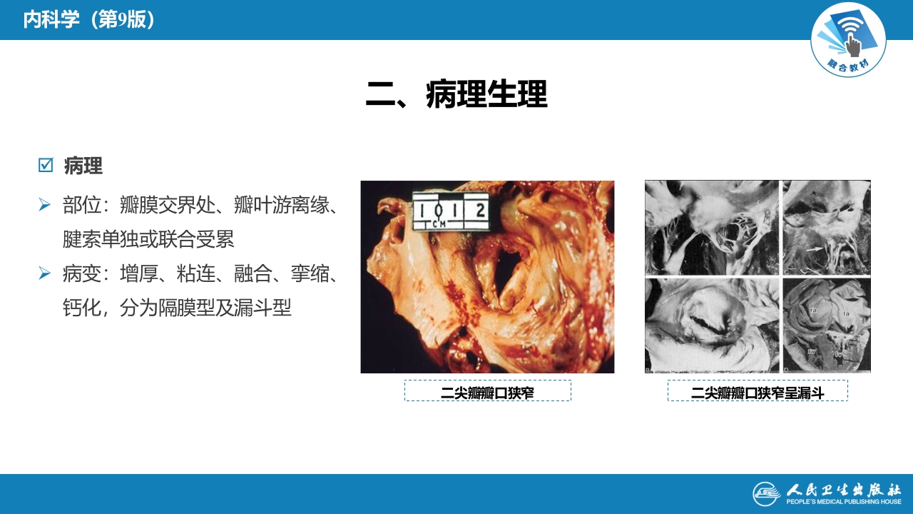 第八章 心脏瓣膜病