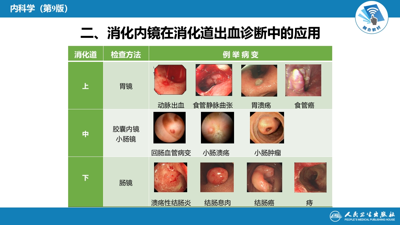 第二十五章 消化道出血