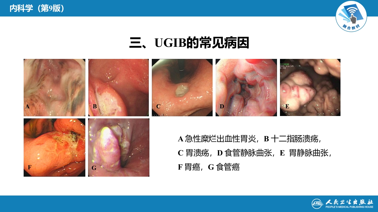 第二十五章 消化道出血