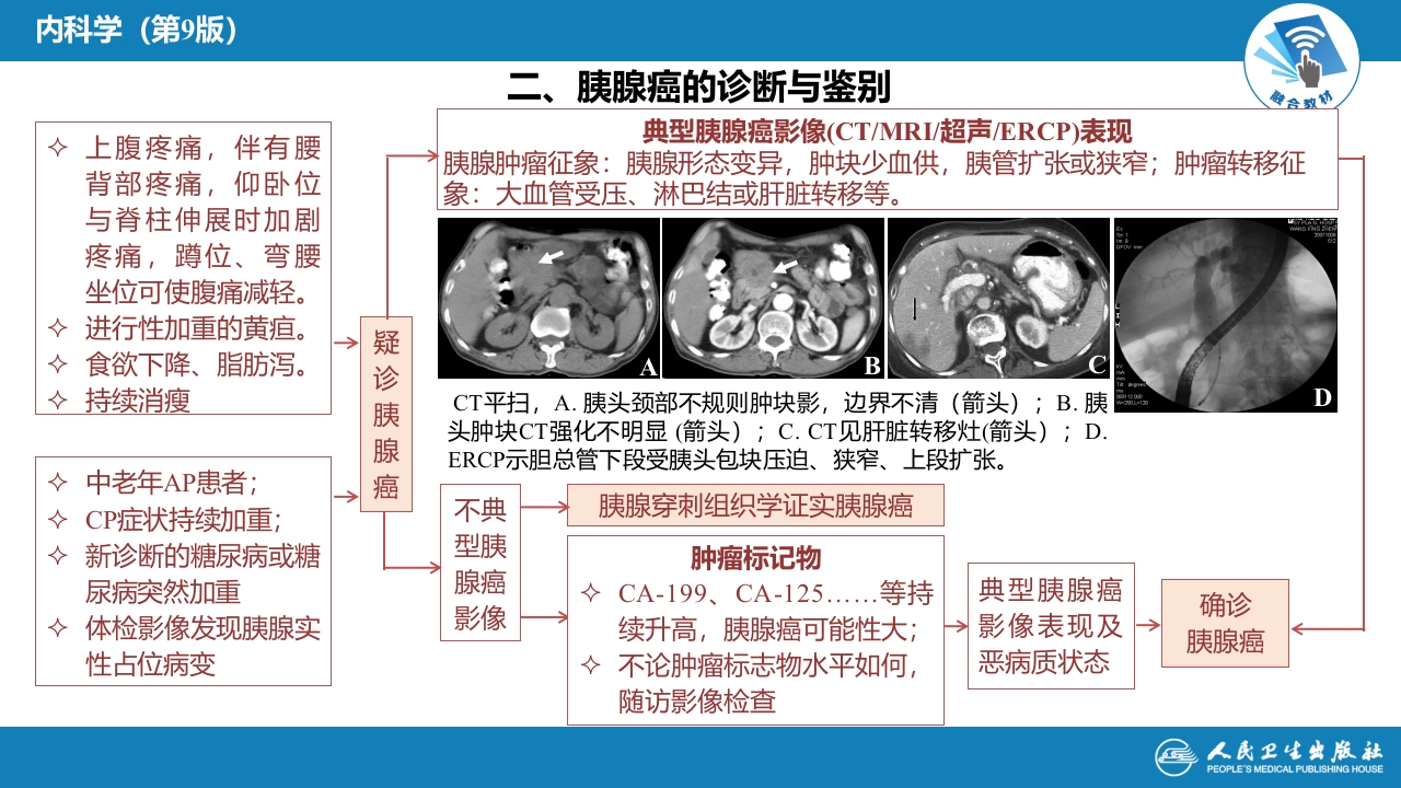 第二十一章 胰腺癌