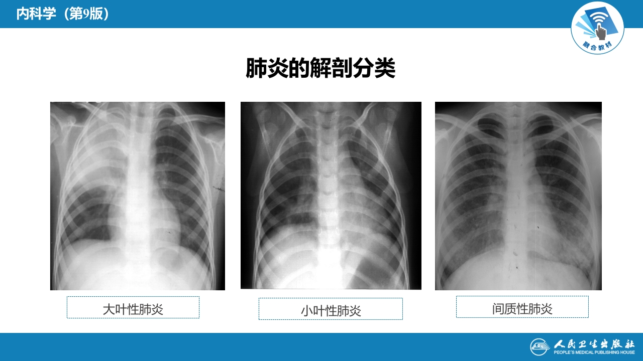 第六章 肺部感染性疾病