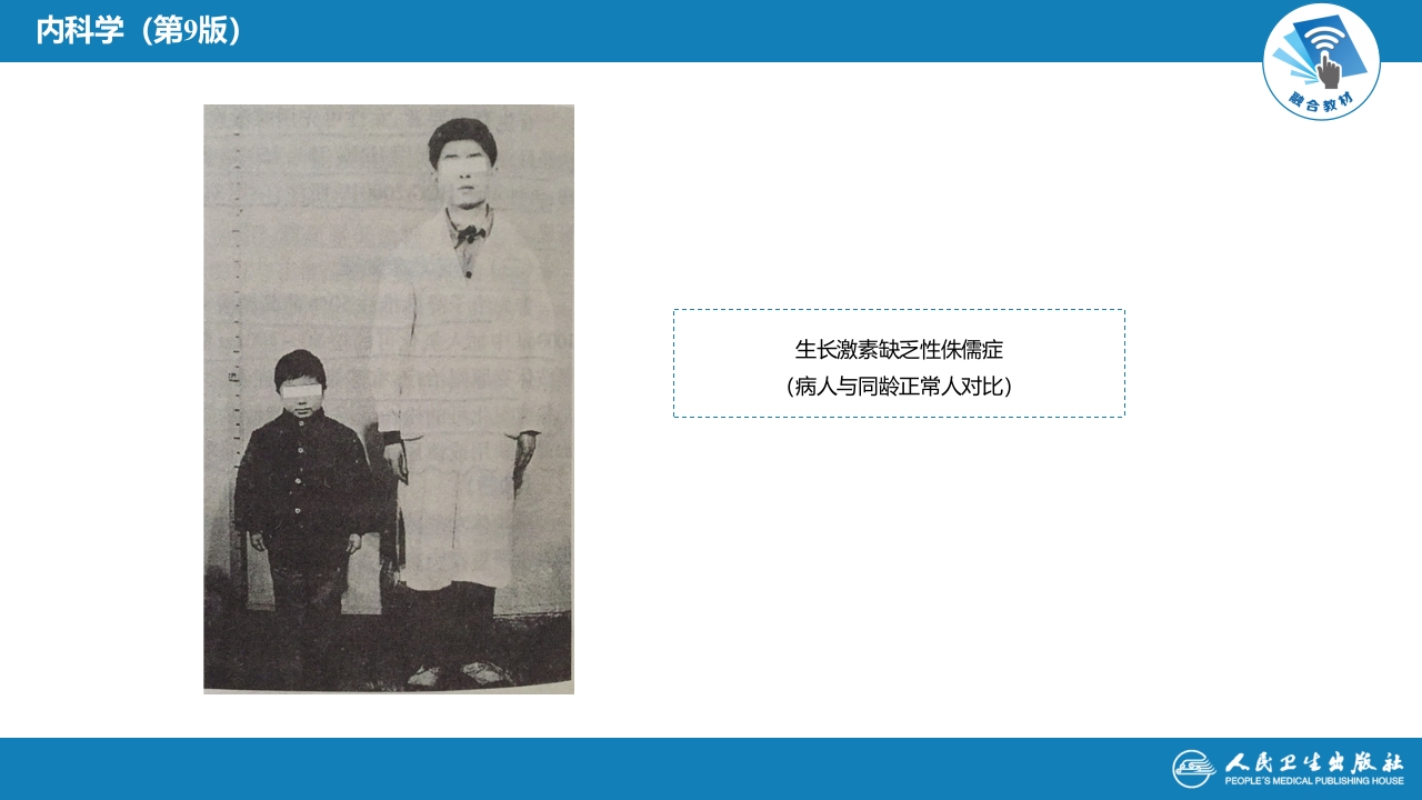 第六章 生长激素缺乏性矮小症