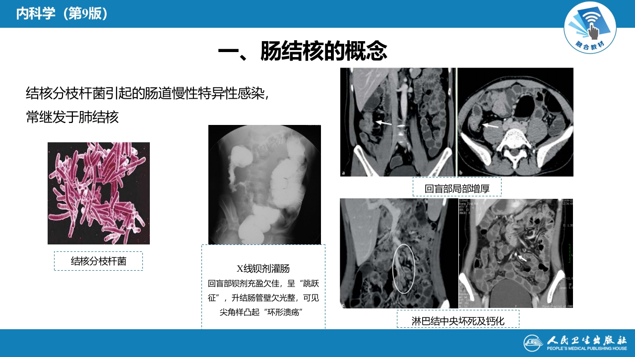 第七章 肠结核和结核性腹膜炎