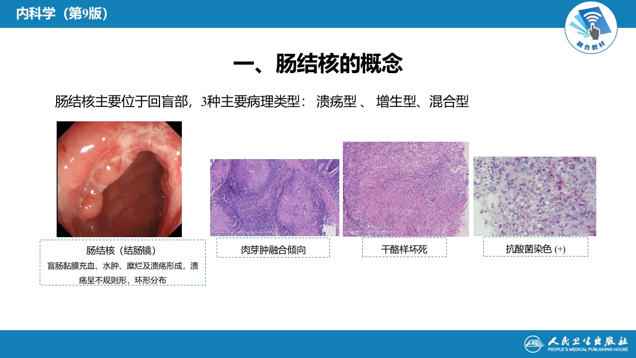 第七章 肠结核和结核性腹膜炎