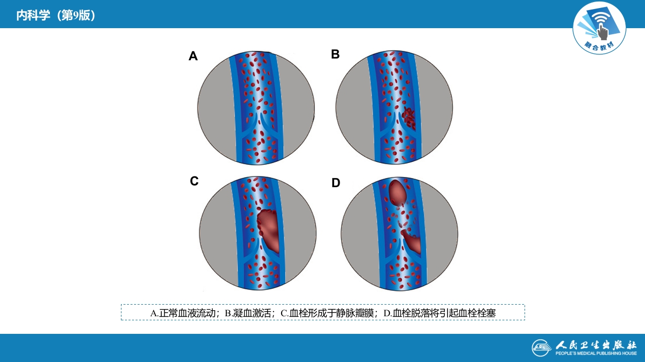 第十八章 血栓性疾病