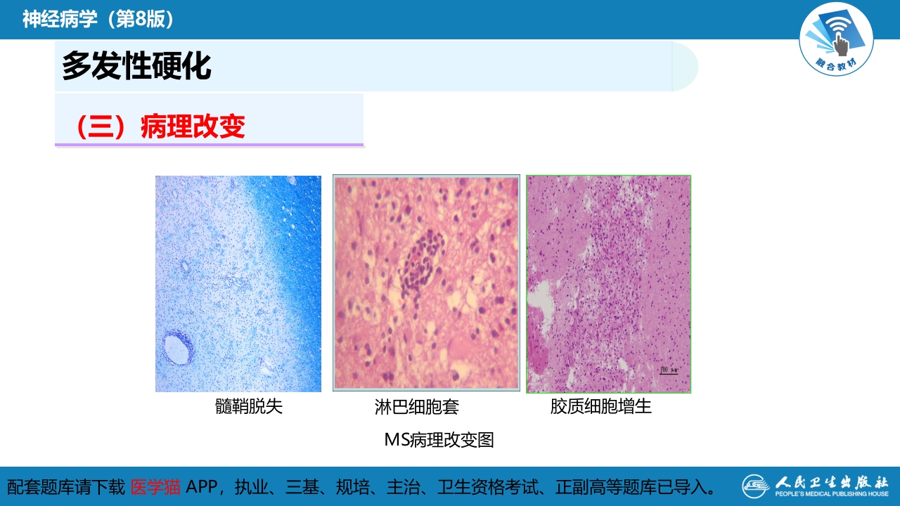 第十三章 中枢神经系统脱髓鞘疾病