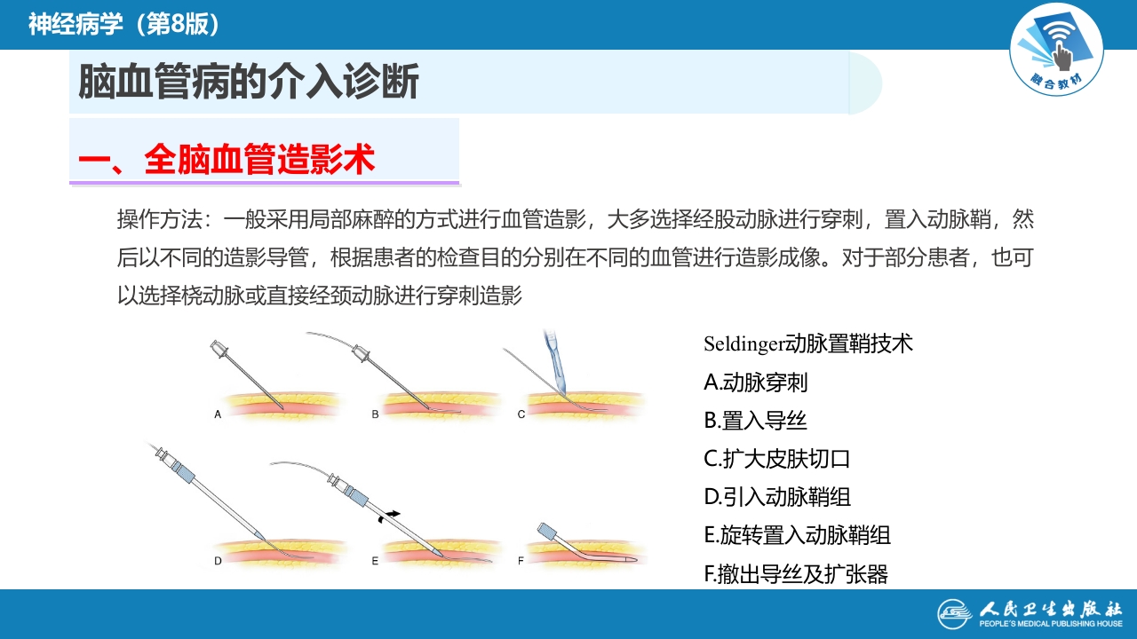 第十章 脑血管病的介入诊疗（1）