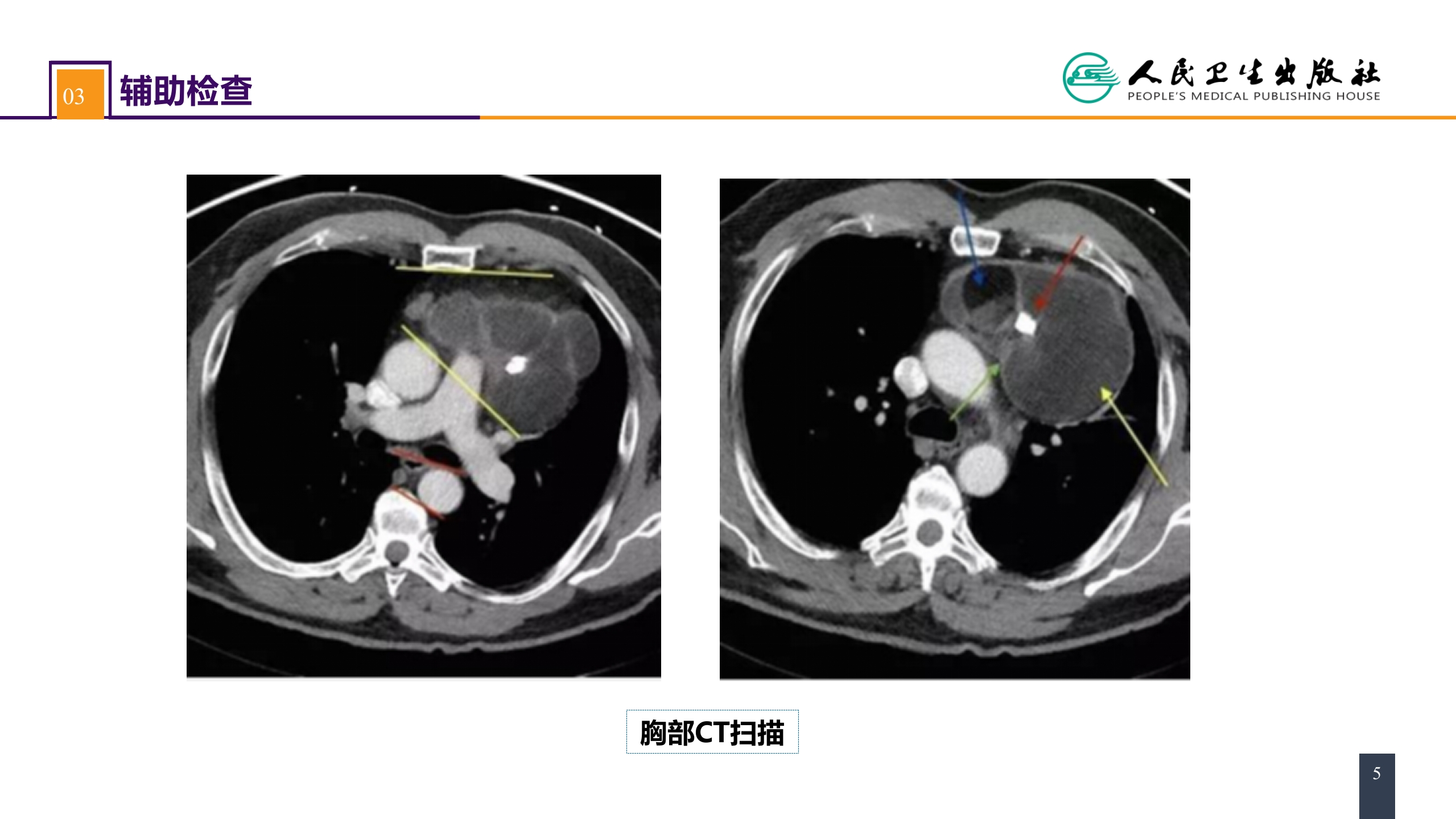 第二十八章 原发性纵隔肿瘤 案例分析-纵隔畸胎瘤