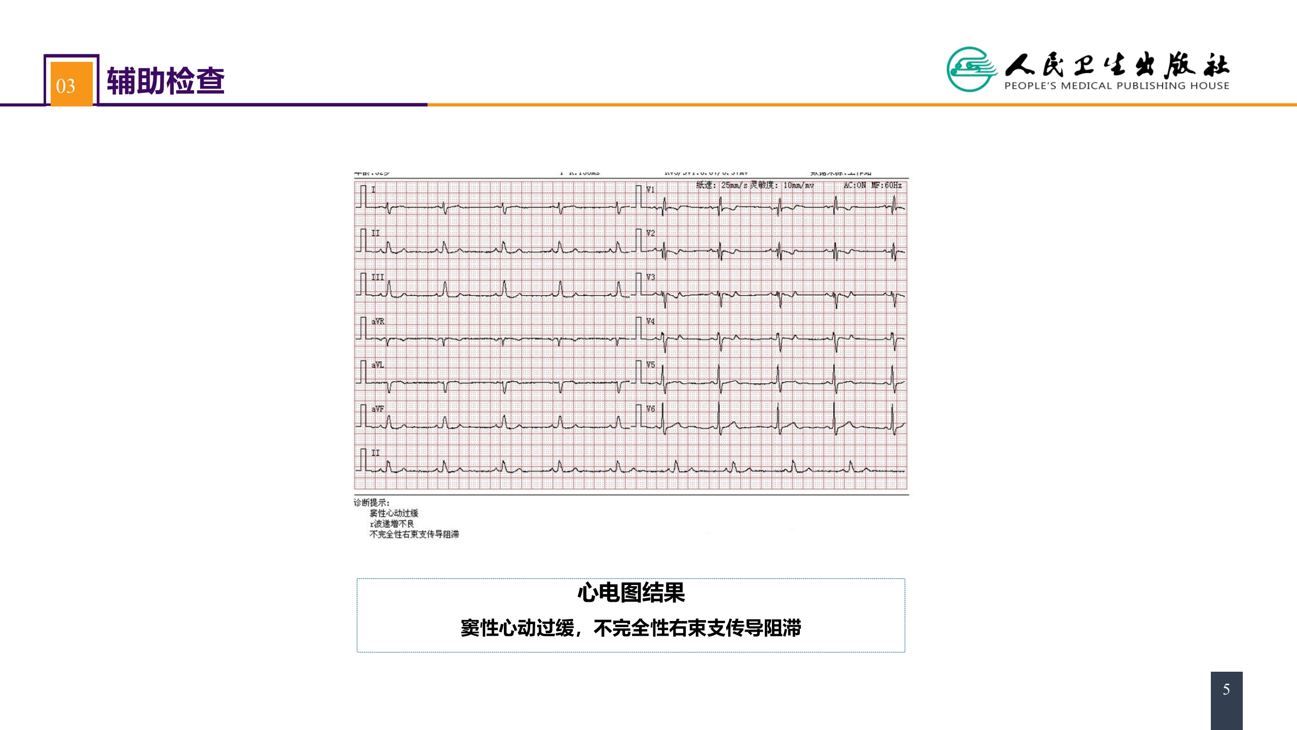 第二十九章 心脏疾病 案例分析-房间隔缺损