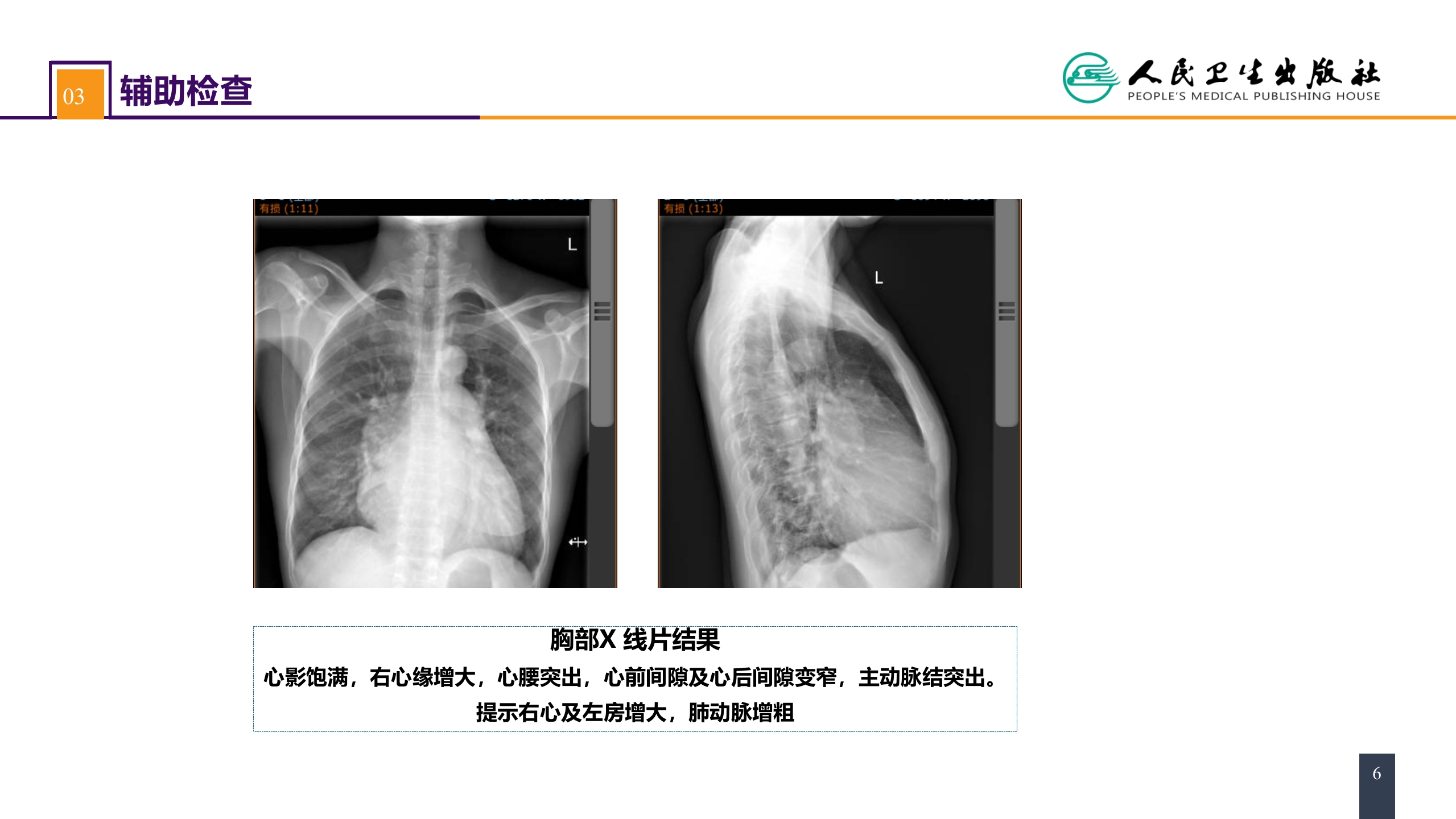 第二十九章 心脏疾病 案例分析-房间隔缺损