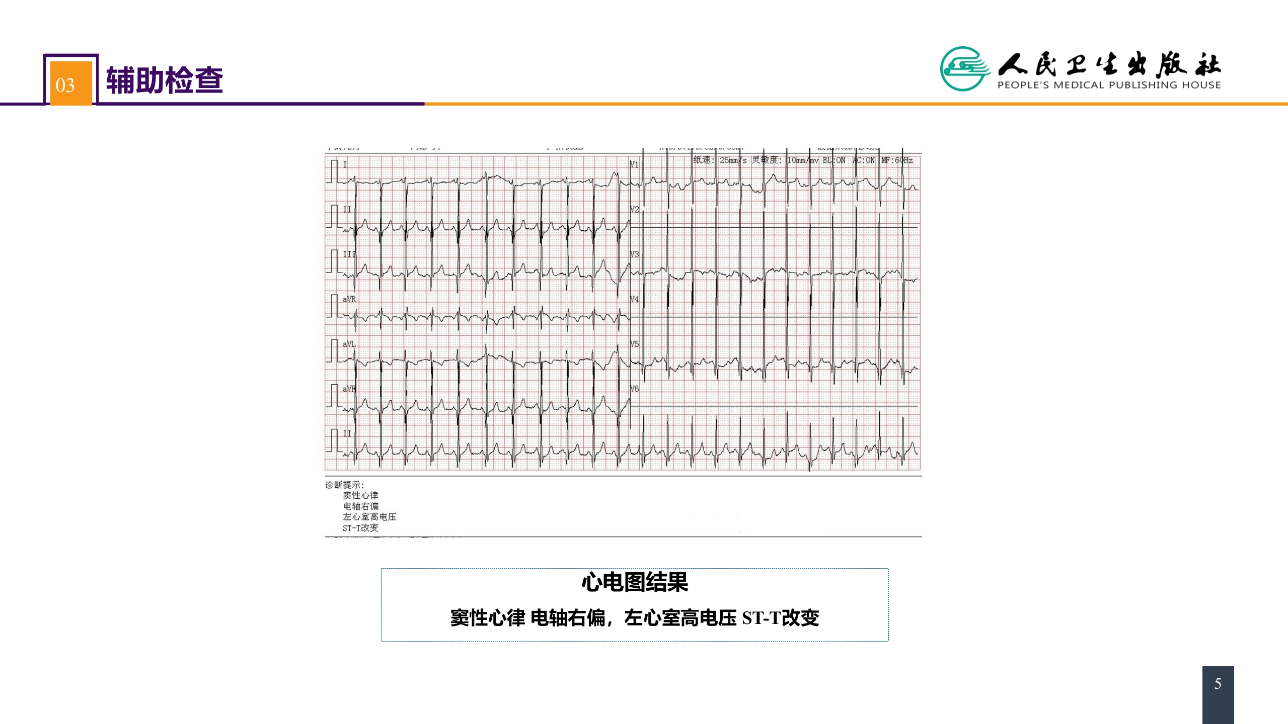 第二十九章 心脏疾病 案例分析-室间隔缺损