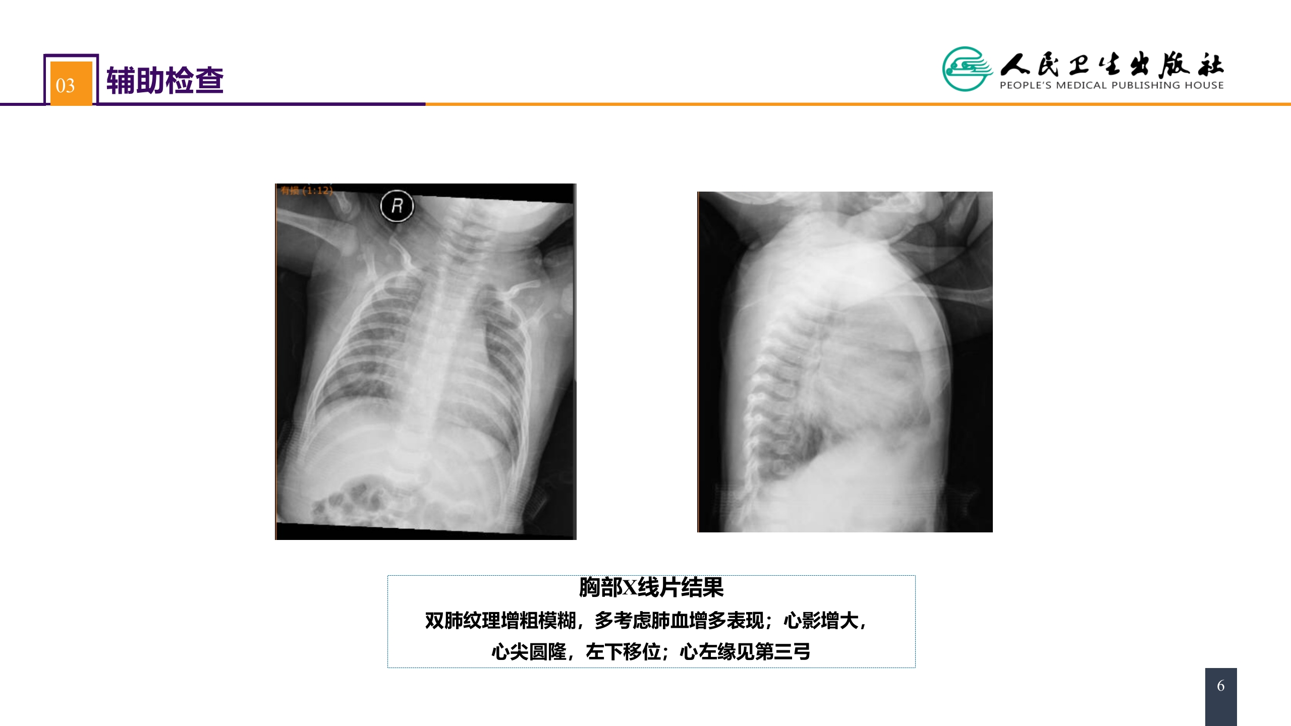 第二十九章 心脏疾病 案例分析-室间隔缺损