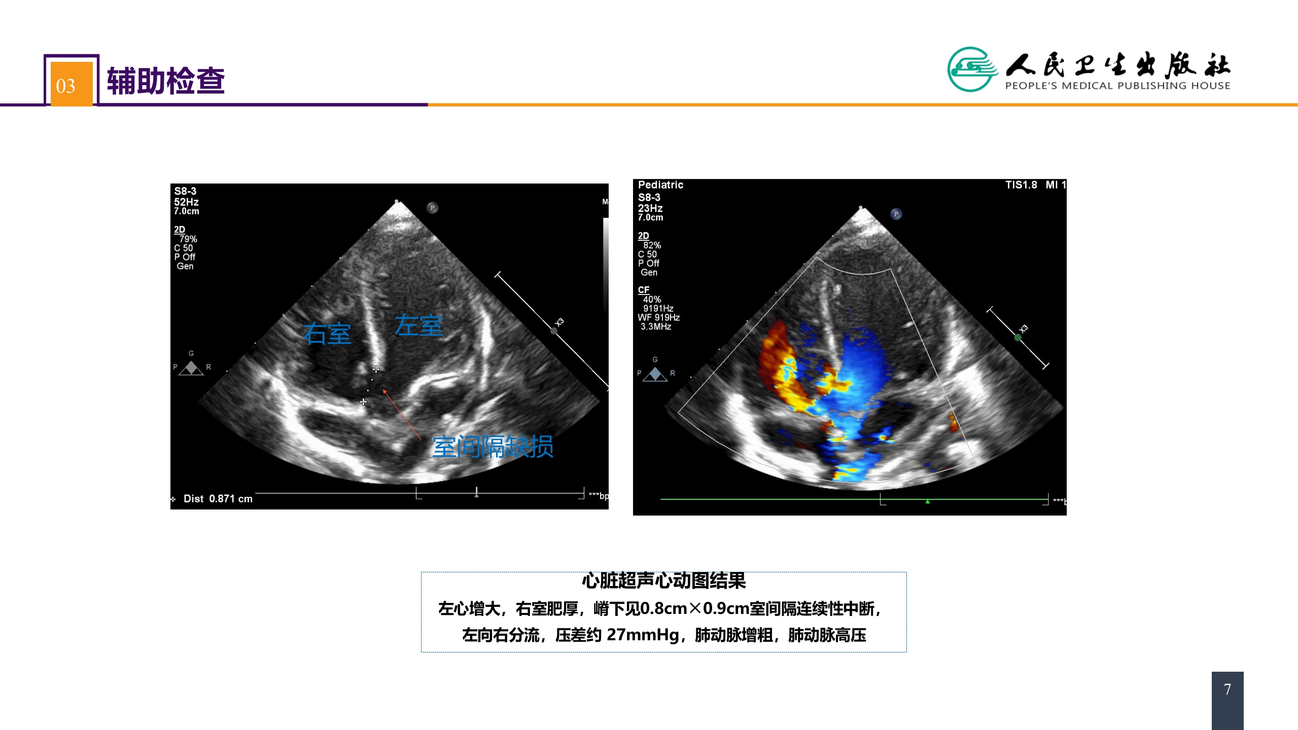 第二十九章 心脏疾病 案例分析-室间隔缺损