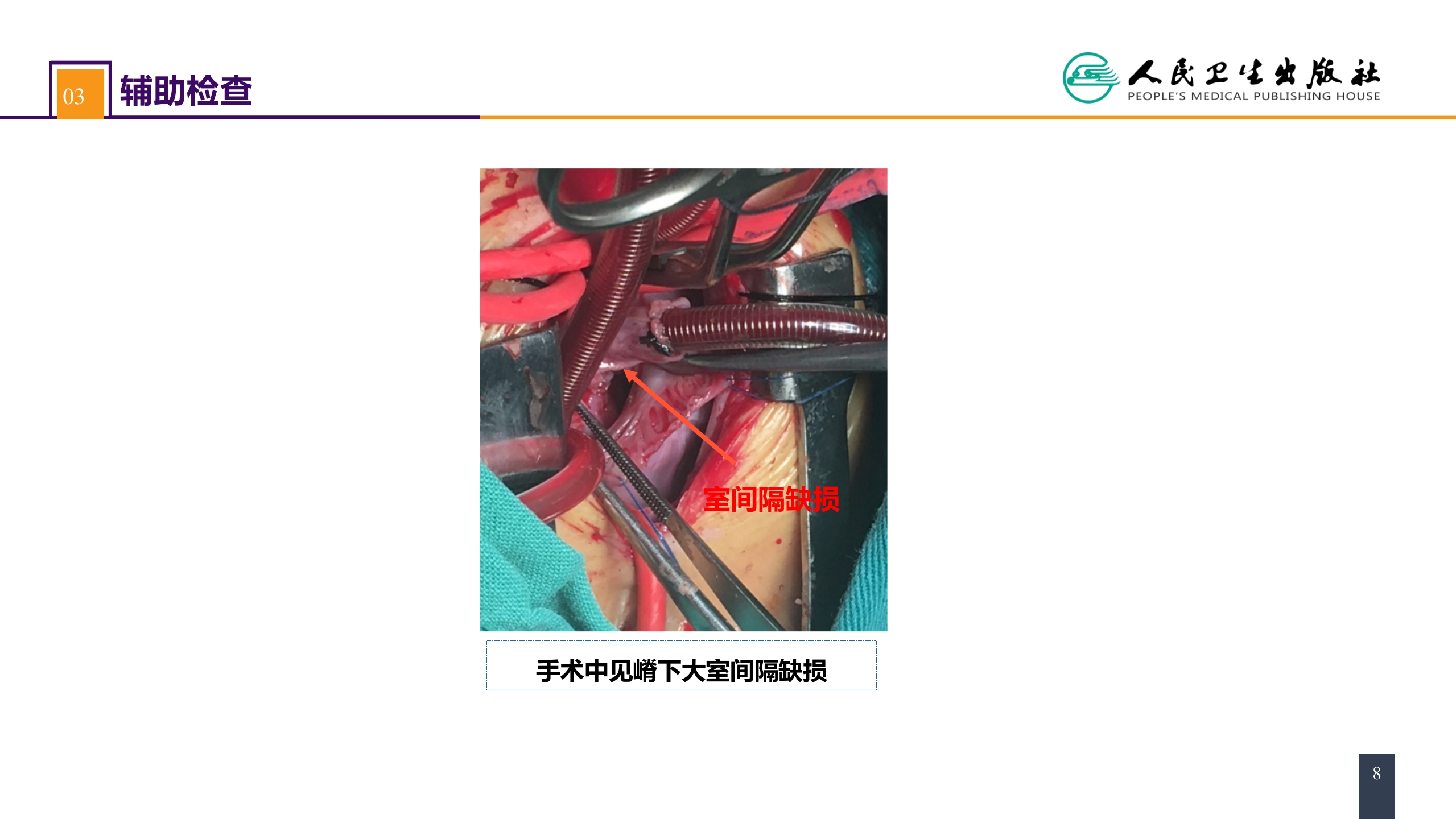 第二十九章 心脏疾病 案例分析-室间隔缺损