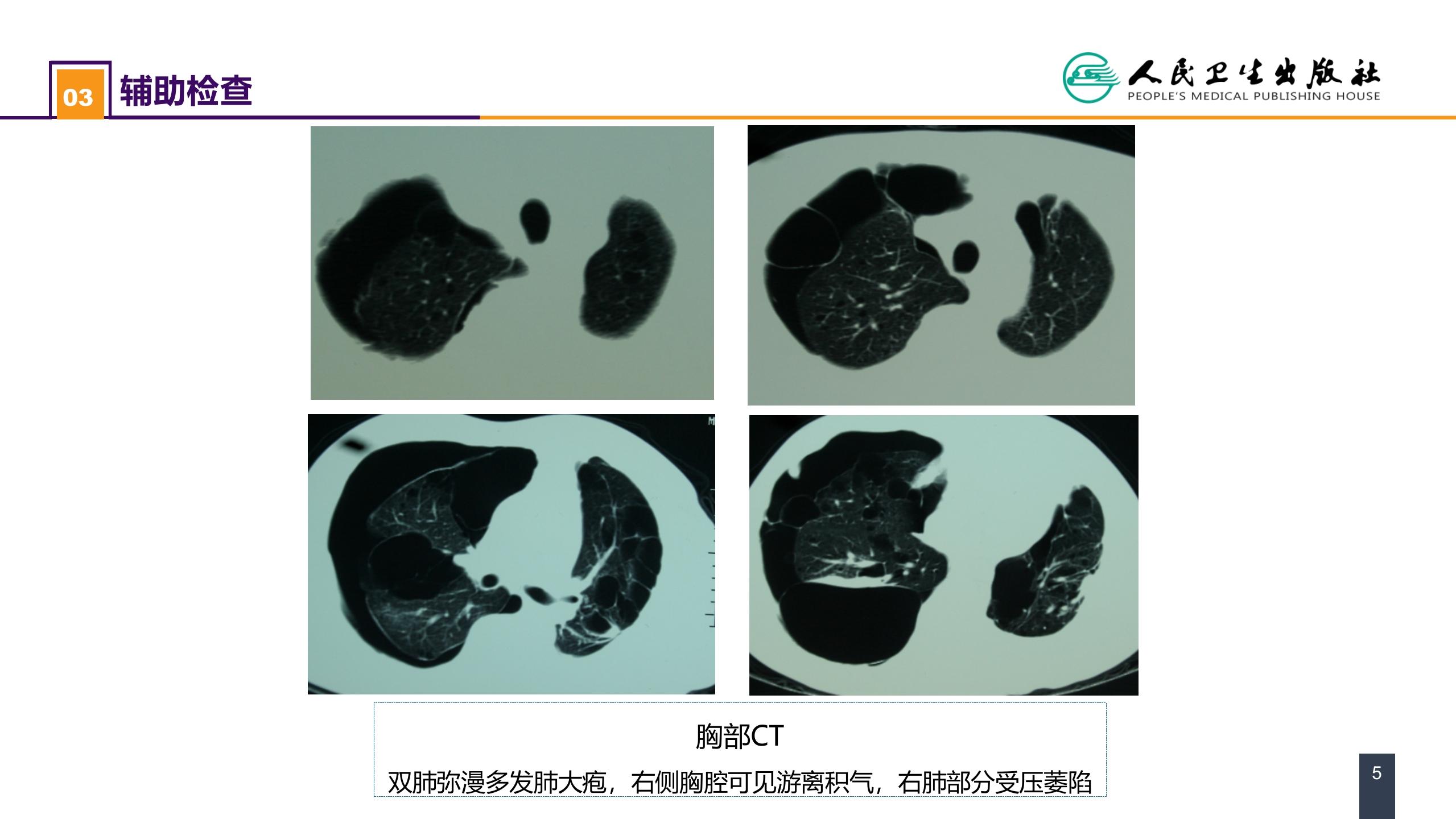 第二十六章 肺部疾病 案例分析-肺大疱合并自发性气胸