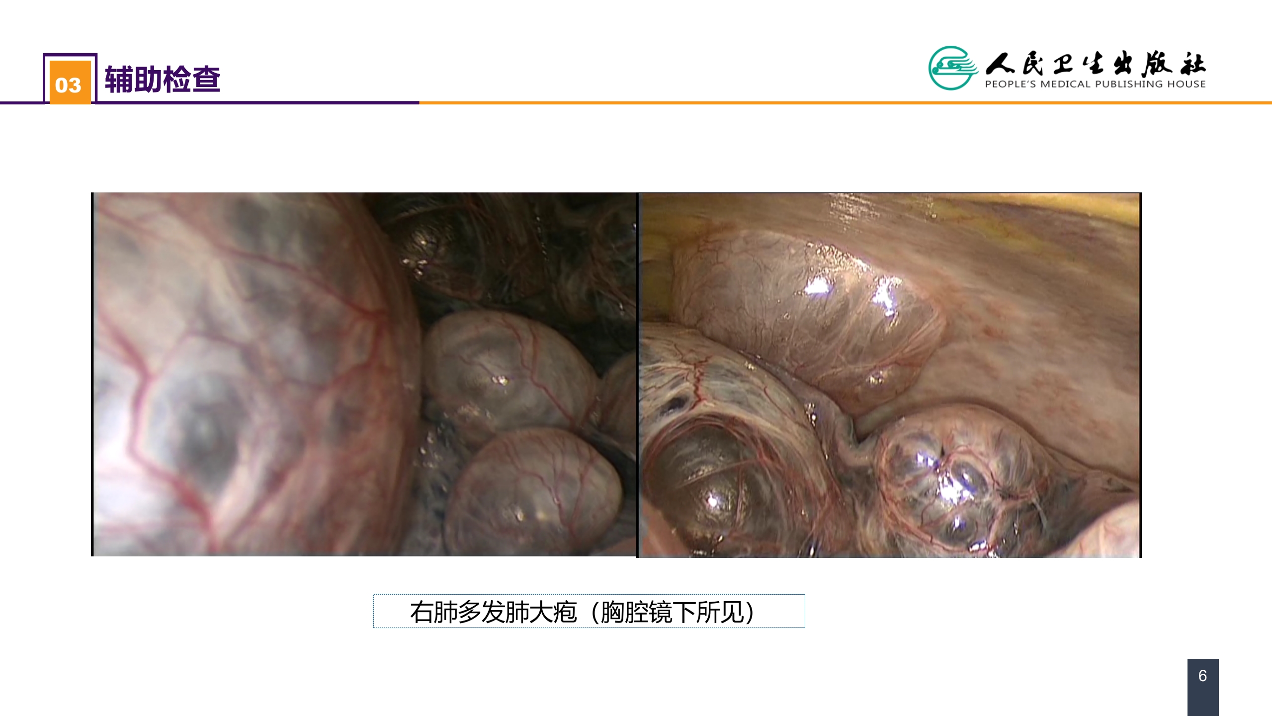 第二十六章 肺部疾病 案例分析-肺大疱合并自发性气胸