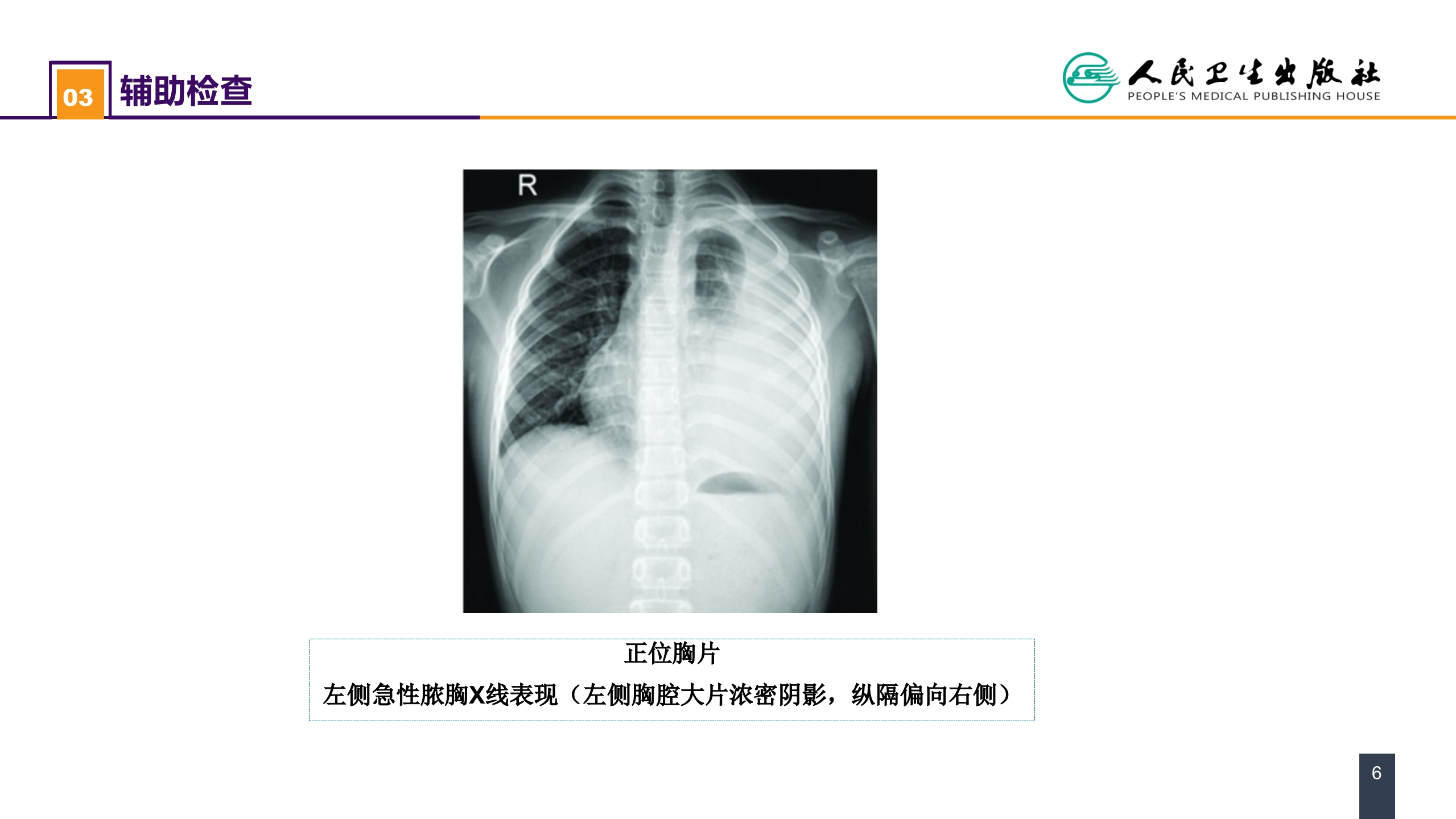 第二十五章 胸壁、胸膜疾病 案例分析-急性脓胸