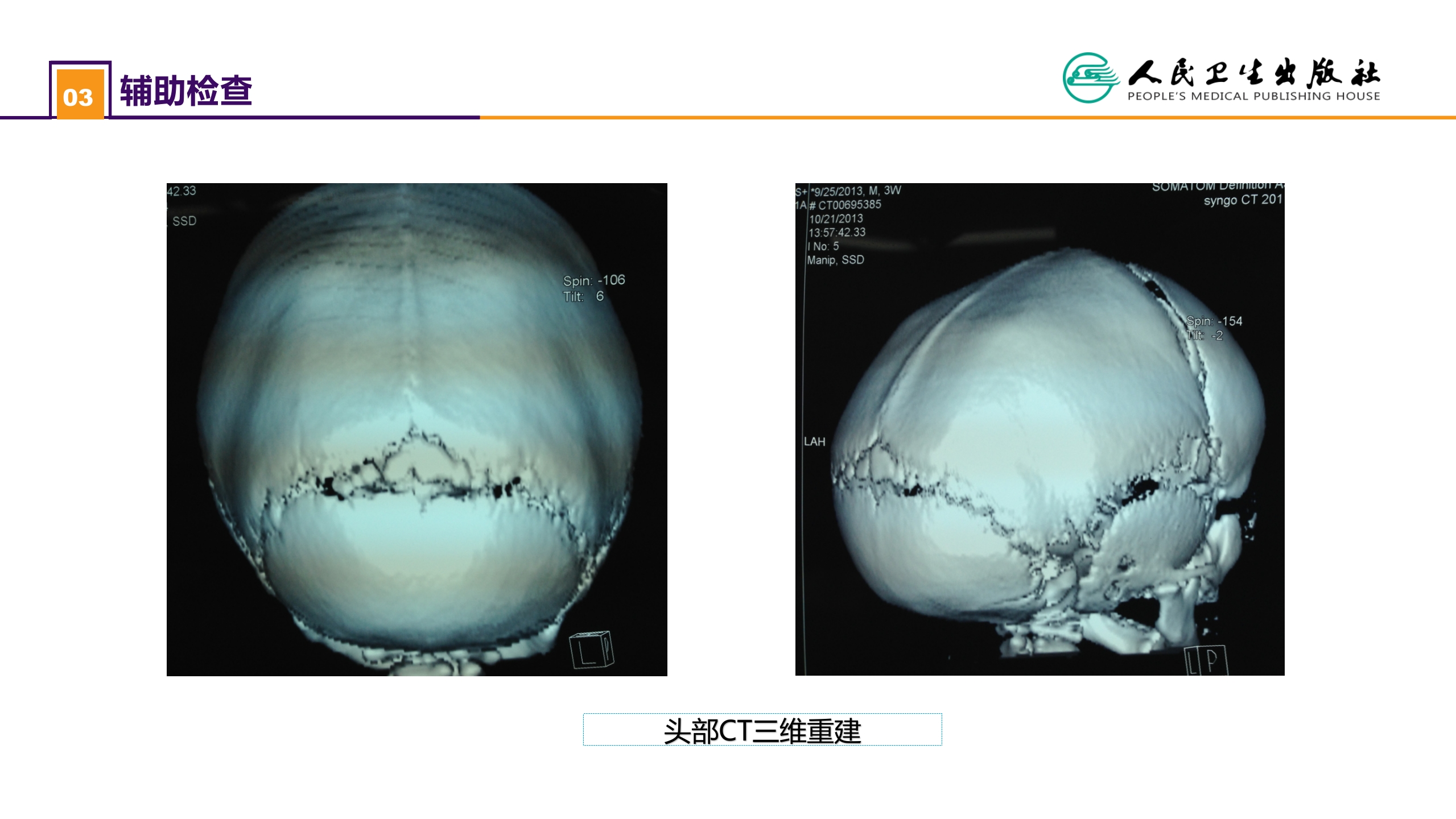 第二十一章 案例分析-矢状缝早闭