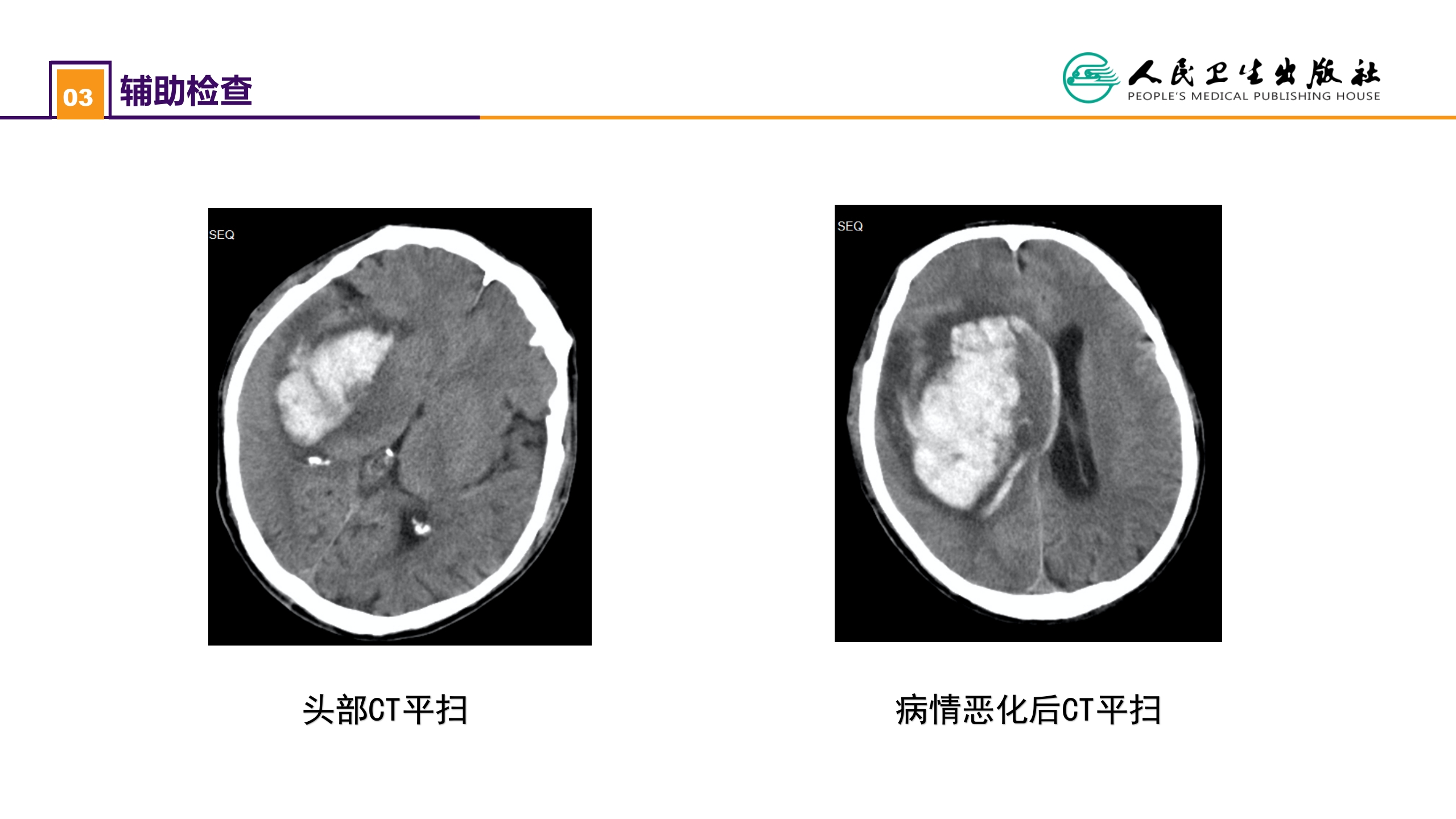 第二十章 案例分析-高血压脑出血