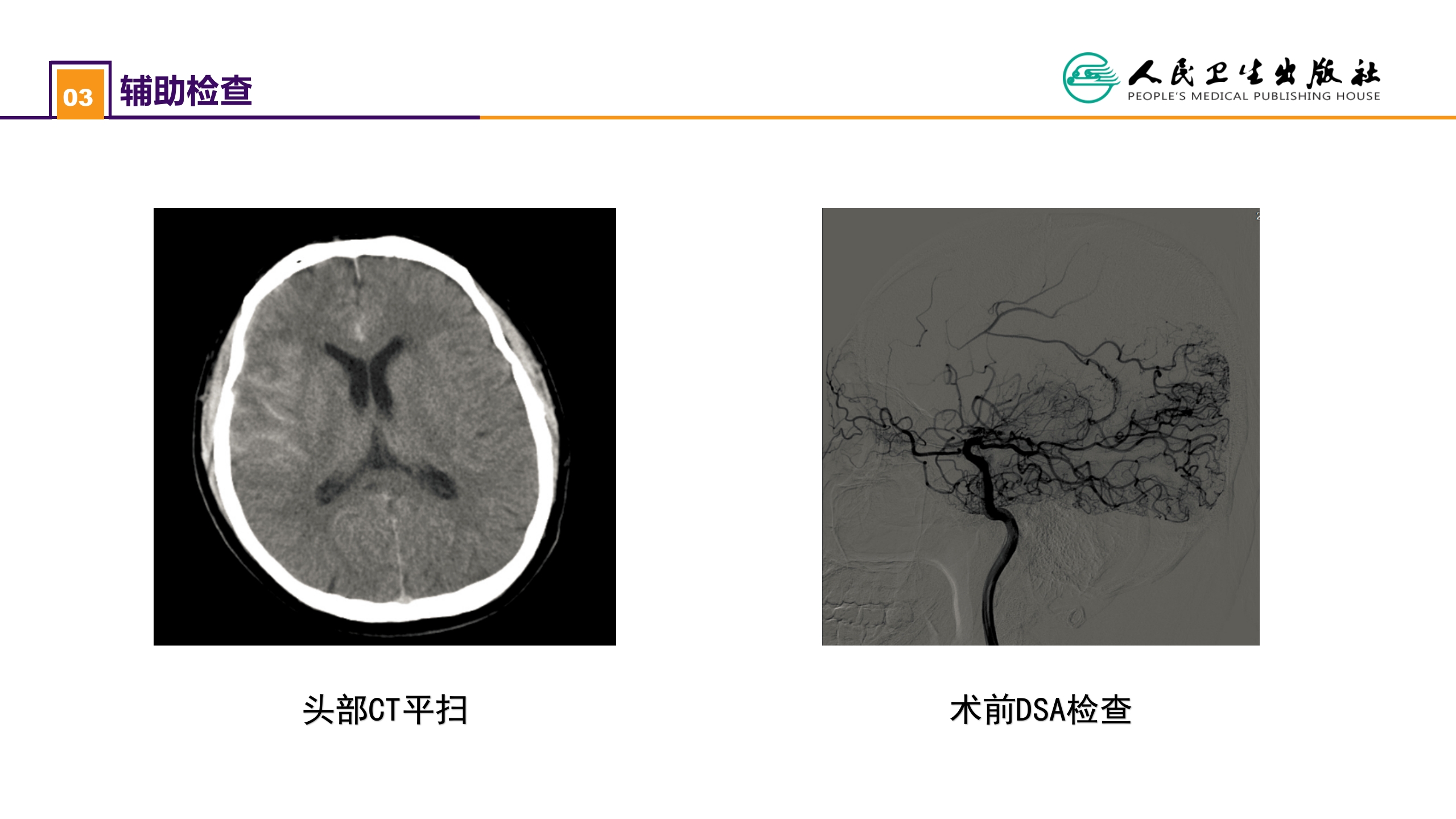 第二十章 案例分析-烟雾病导致的蛛网膜下腔出血
