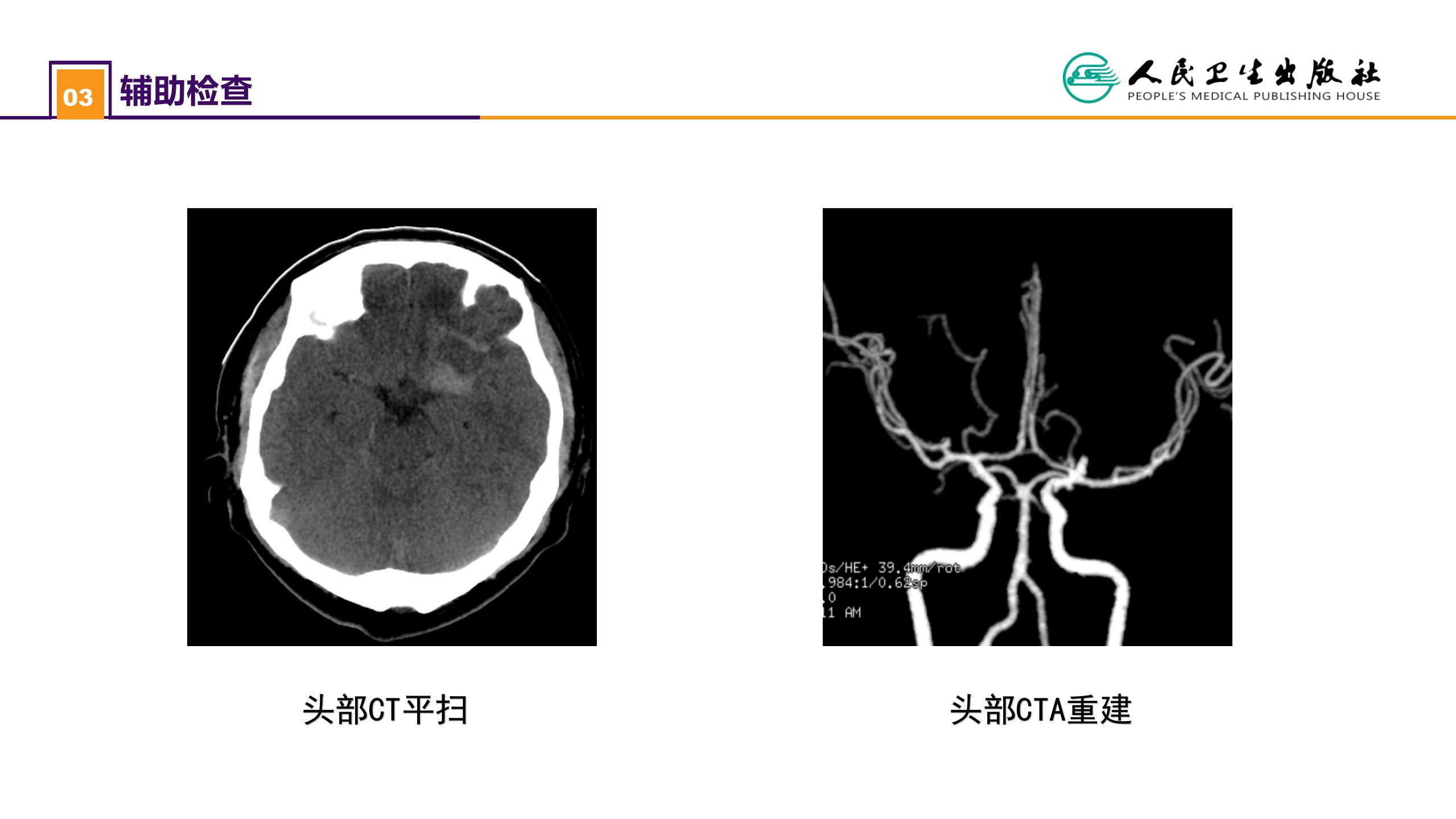 第二十章 案例分析-颅内动脉瘤破裂导致的蛛网膜下腔出血