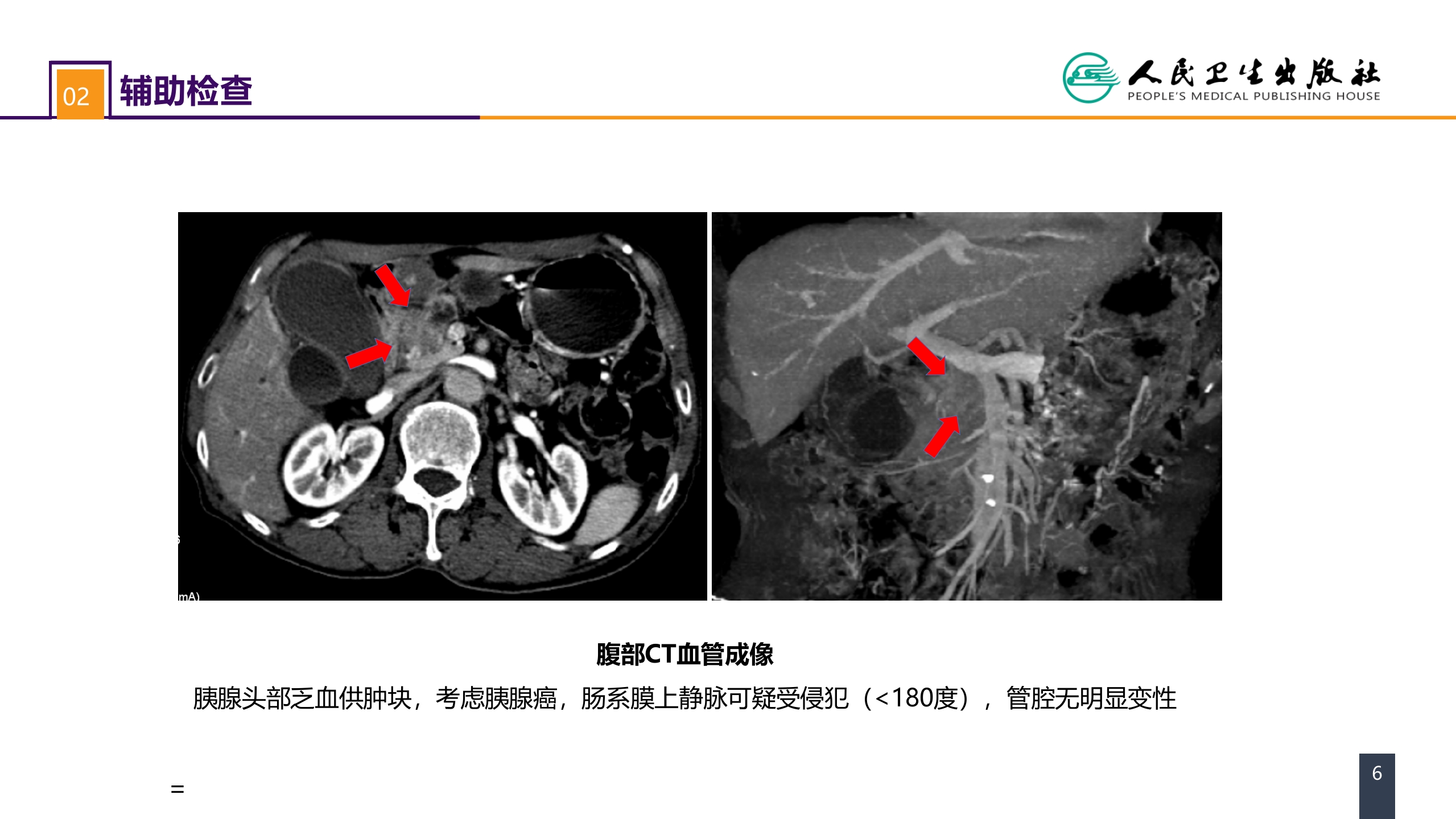第九章 案例分析-ERAS路径下胰十二指肠切除术一例