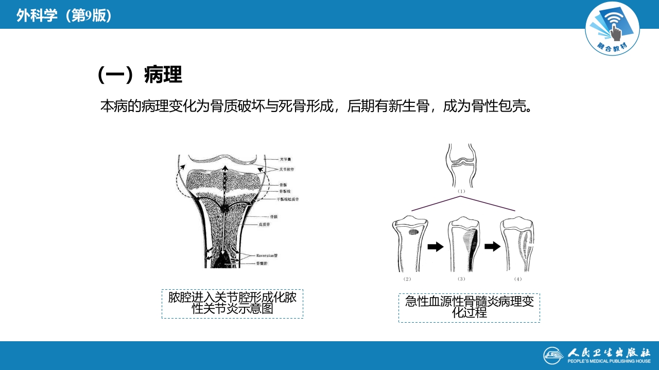 第六十八章 骨与关节化脓性感染