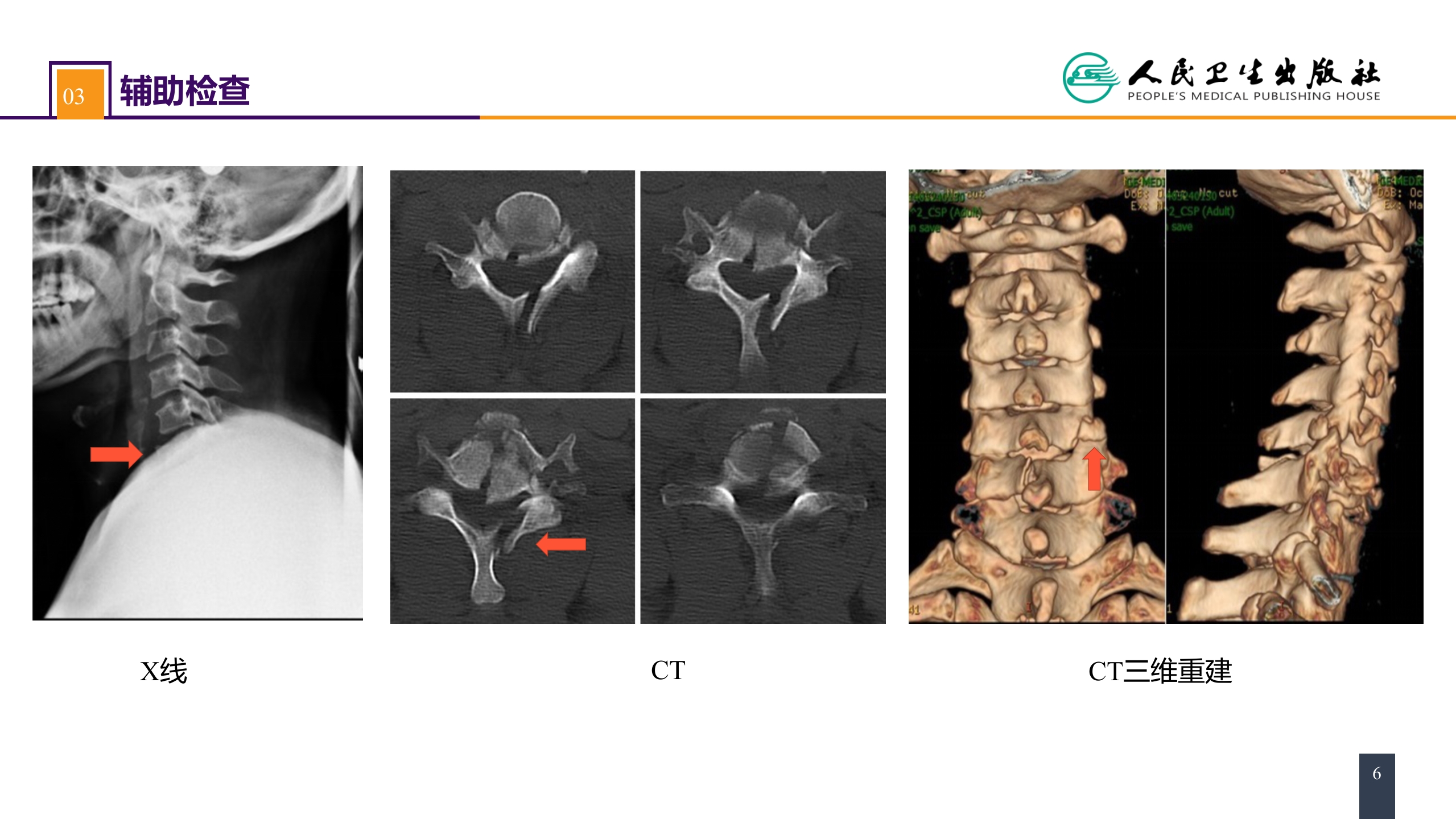 第六十二章 案例分析-颈椎骨折伴脊髓损伤