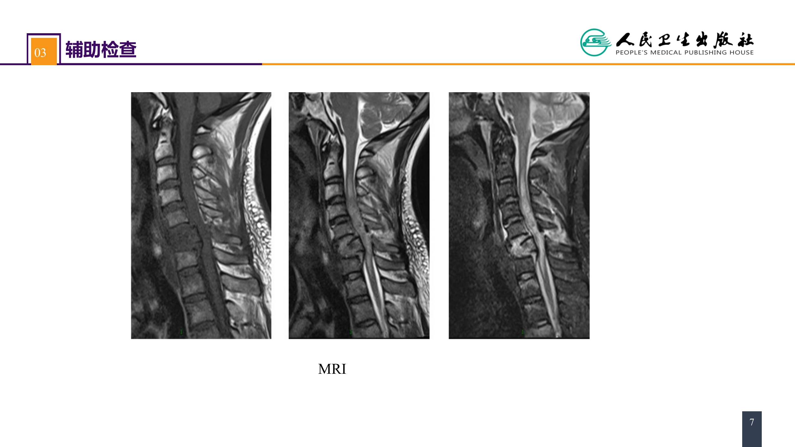 第六十二章 案例分析-颈椎骨折伴脊髓损伤
