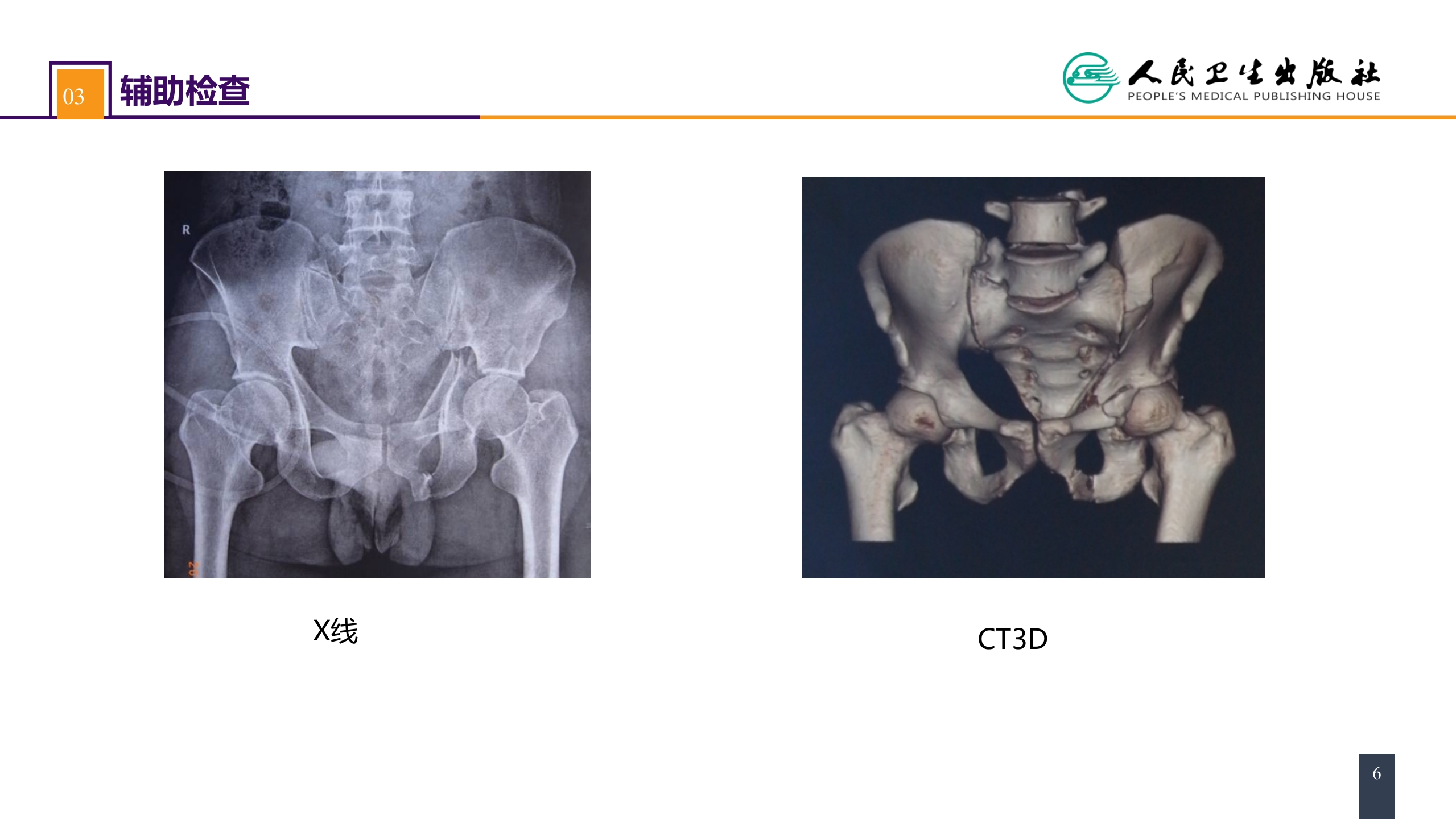 第六十三章 案例分析-髋臼骨折
