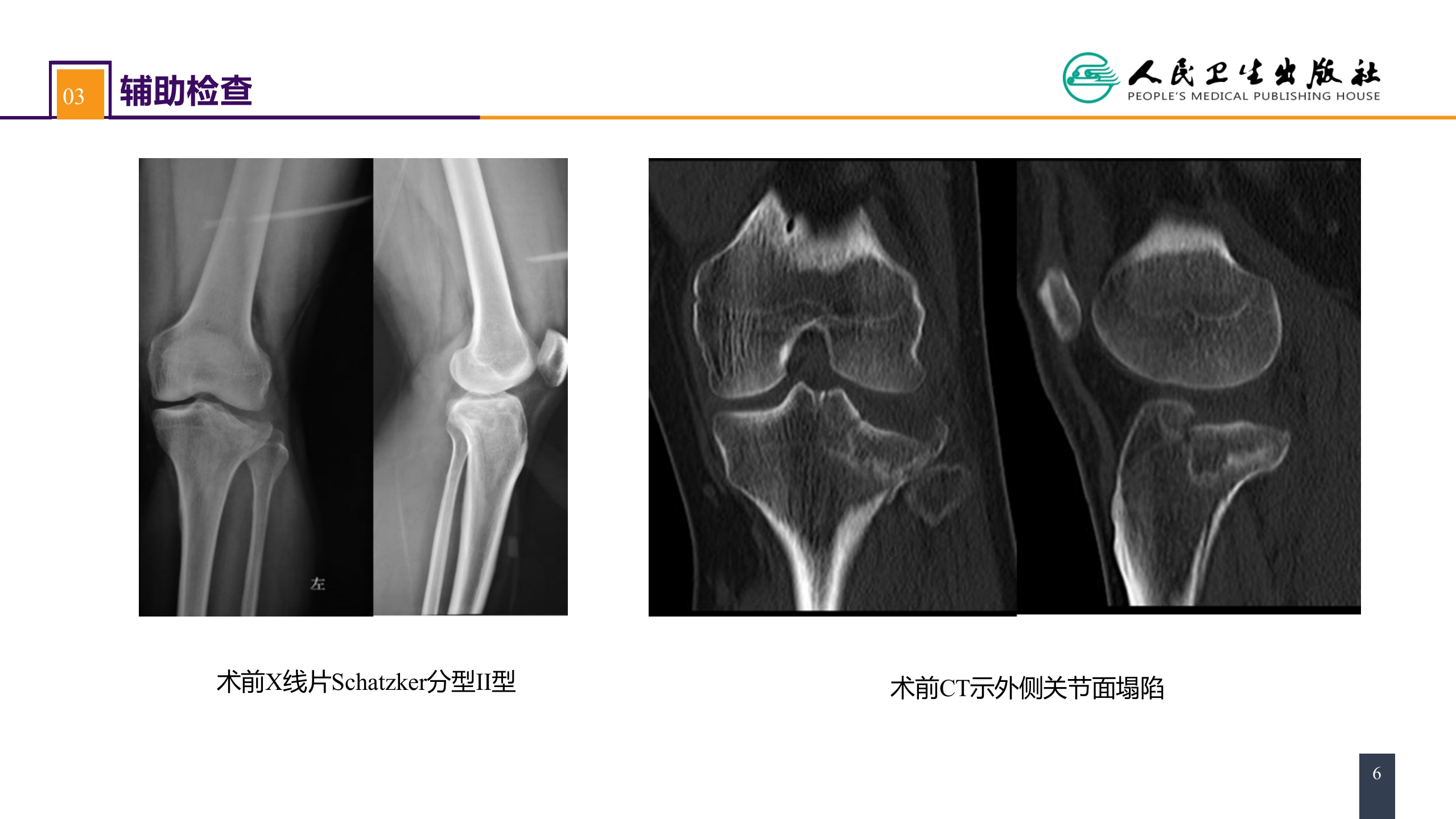 第六十一章 下肢骨、关节损伤 案例分析-胫骨平台骨折