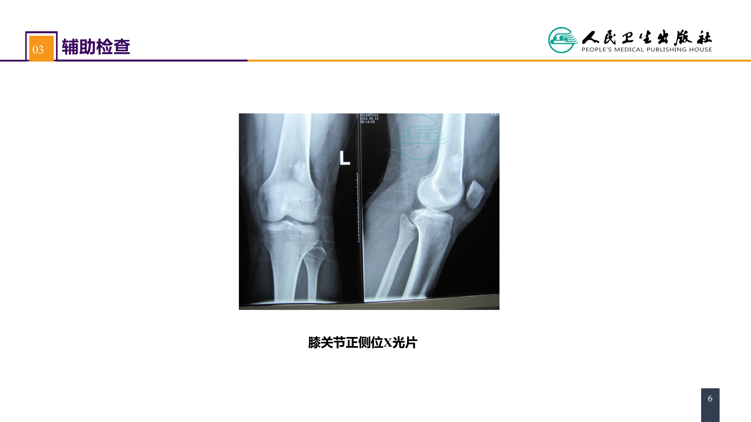 第七十一章 案例分析-骨肿瘤