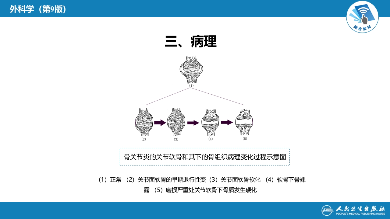 第七十章 非化脓性关节炎