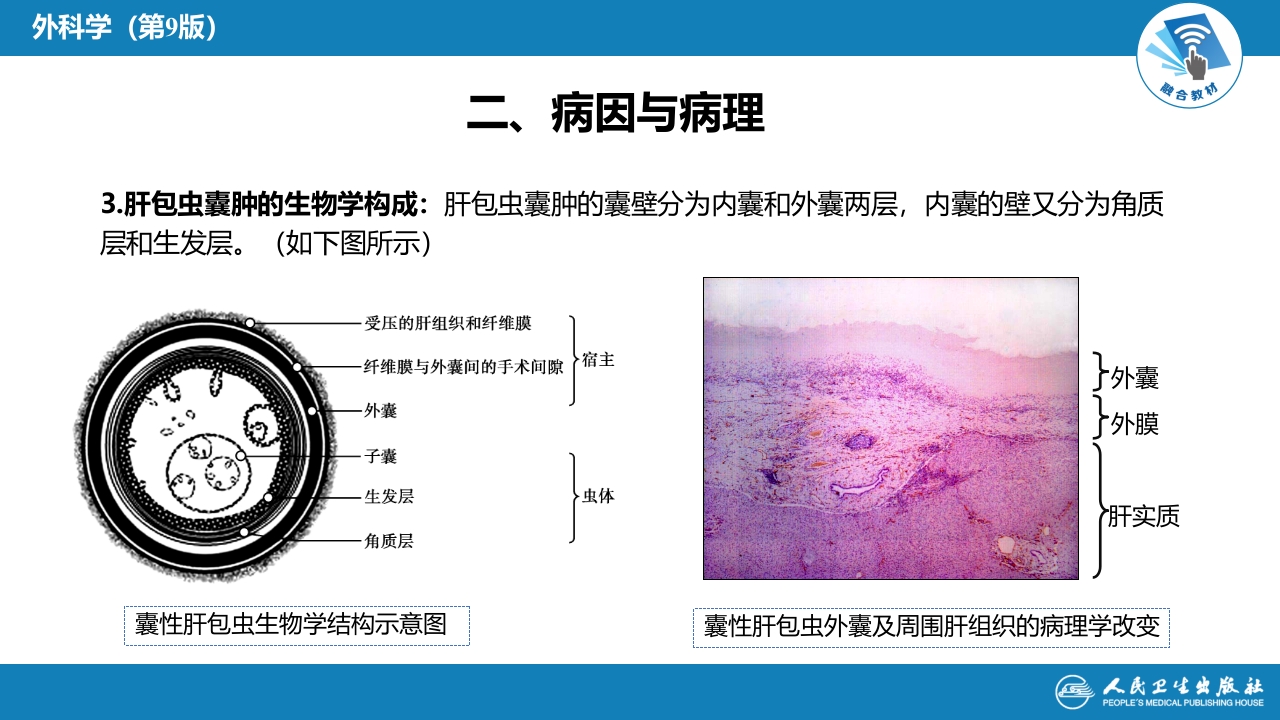 第三十八章 肝疾病 第四节 肝棘球蚴病
