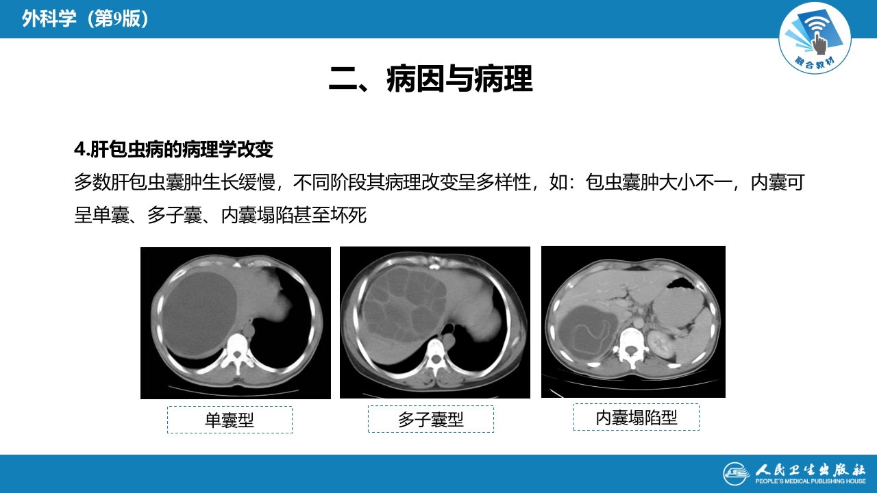 第三十八章 肝疾病 第四节 肝棘球蚴病