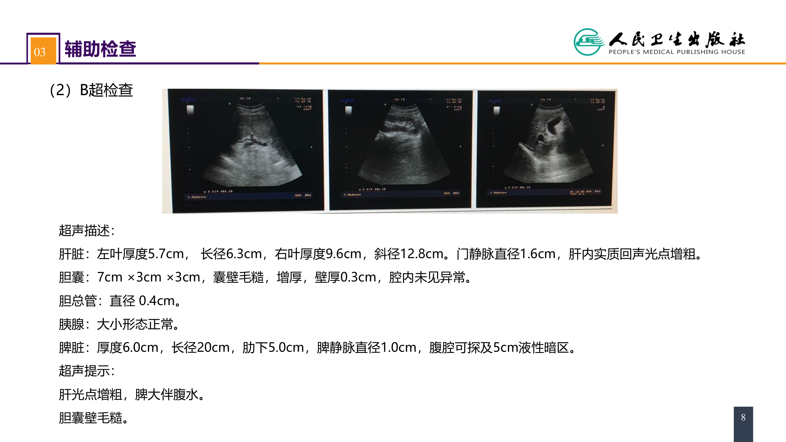 第三十九章 门静脉高压症 案例分析-门静脉高压症