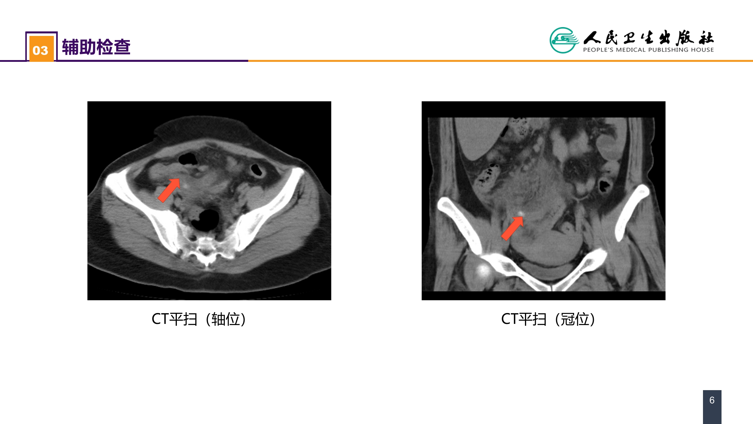 第三十六章 阑尾疾病 案例分析-急性化脓性阑尾炎
